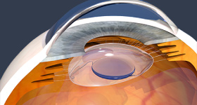 日帰り白内障手術