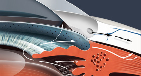 日帰り緑内障手術