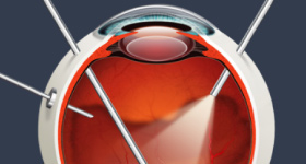 日帰り網膜・硝子体手術