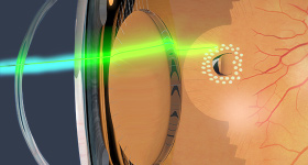 眼科レーザー治療